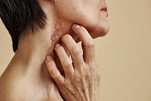 Bild zum Artikel: Psoriasis im Gesicht