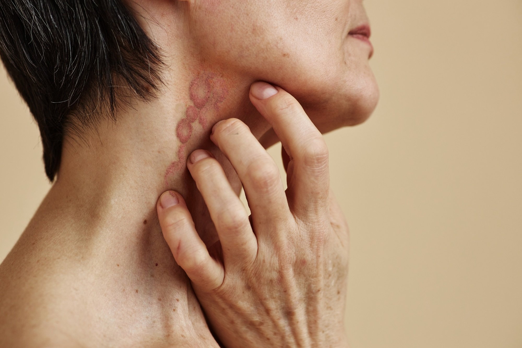 Psoriasis im Gesicht