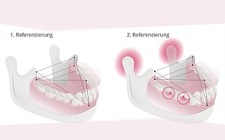 Intraoralscanner ermöglicht computergestützte Zahnrestaurationen mit Cerec (dentales CAD/CAM-System)