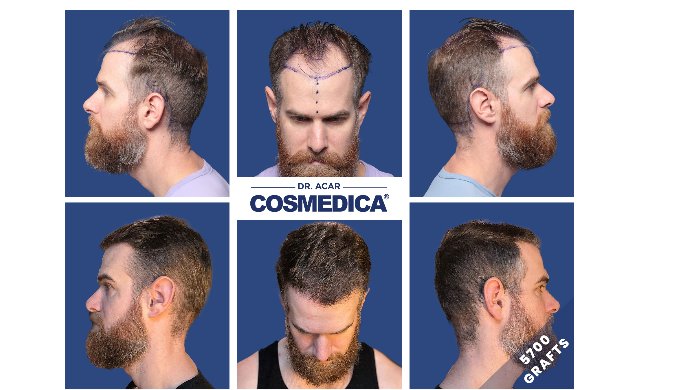 Vorher nachher Vergleich - Haartransplantation-Türkei-All-inclusive Vorher nachher Vergleich - Haartransplantation-Türkei-All-inclusive