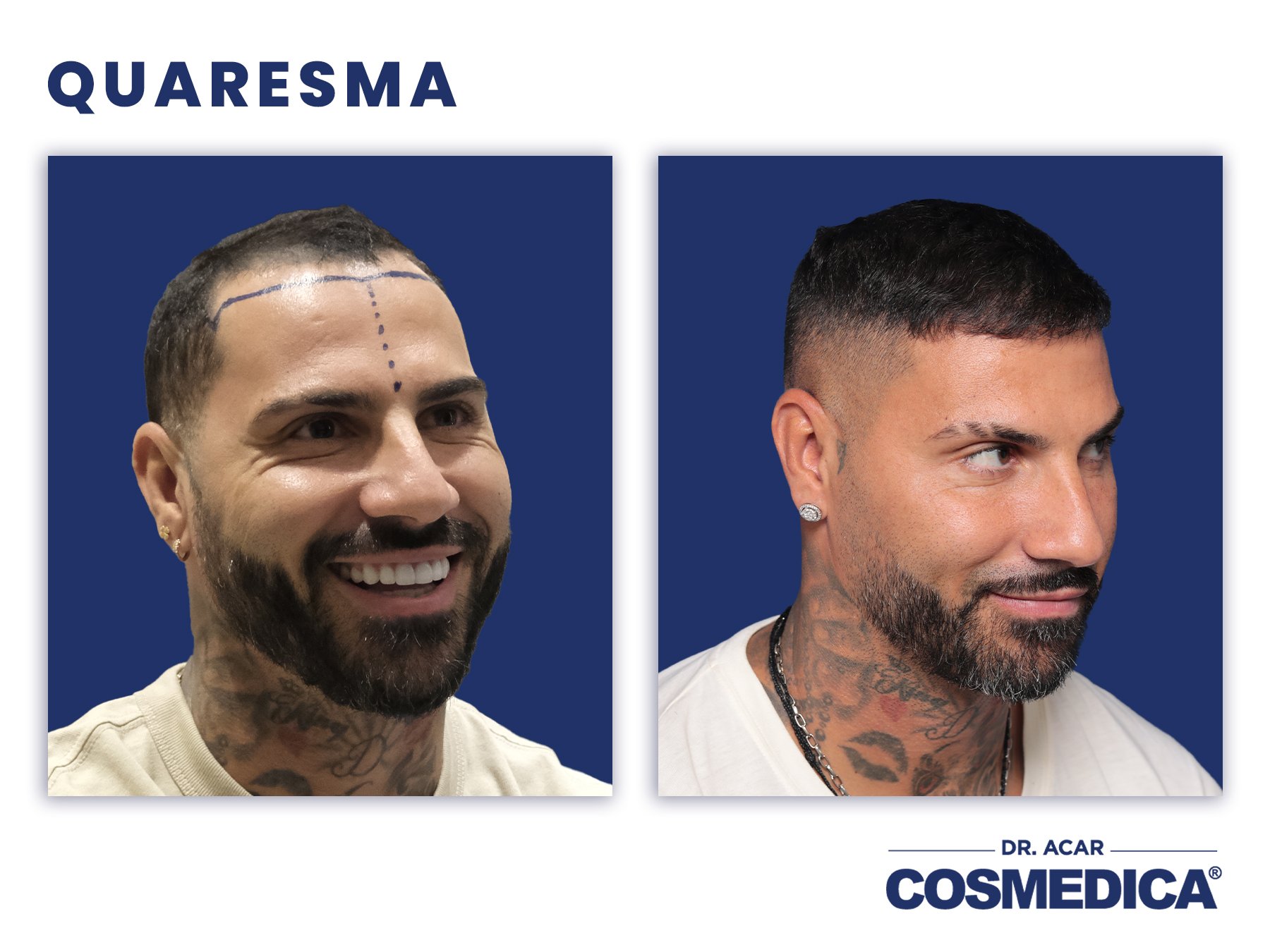 Türkische Haartransplantation in der Cosmedica Clinic