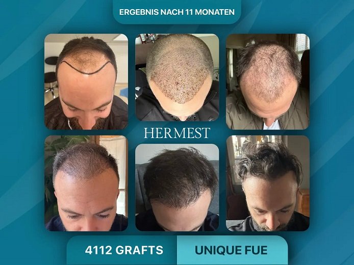 Haartransplantation Kosten Deutschland vs. Türkei