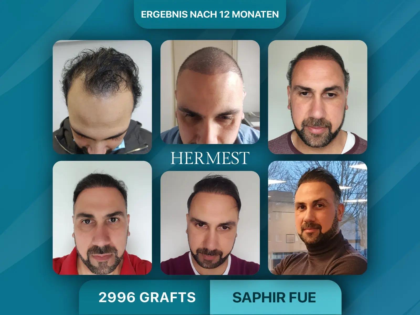 Haartransplantation Kosten Deutschland vs. Türkei