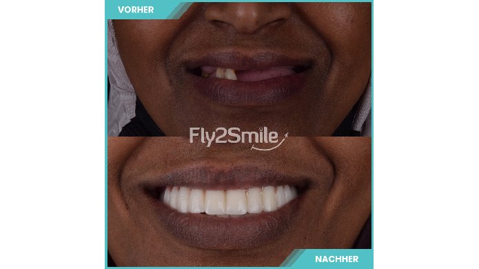 Implantatlösung All on 4