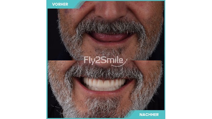 Implantatlösung All on 4