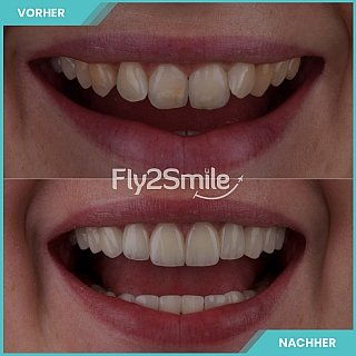 Veneers-Türkei-Erfahrung