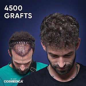 Haartransplantation in der Türkei: Kosten