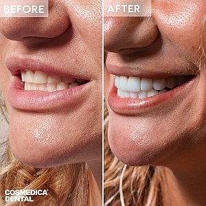 Veneers in der Türkei