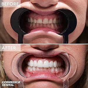 Veneers in der Türkei