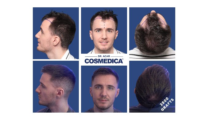 Beste Haartransplantation: Türkei setzt Maßstäbe Beste Haartransplantation: Türkei setzt Maßstäbe
