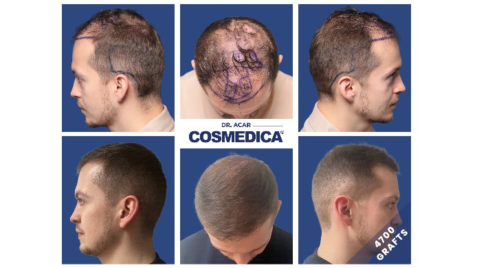 Haartransplantation-Türkei-Testsieger Haartransplantation-Türkei-Testsieger