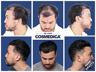 Bild zum Artikel: Haartransplantation Istanbul