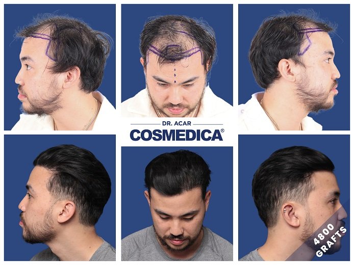 Haartransplantation Istanbul vorher nachher