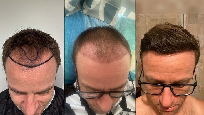 Haartransplantation Türkei Erfahrung Haartransplantation Türkei Erfahrung