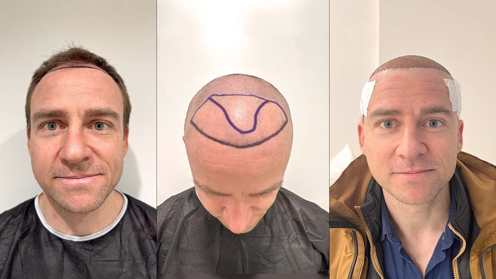 Haartransplantation Türkei Erfahrung Haartransplantation Türkei Erfahrung