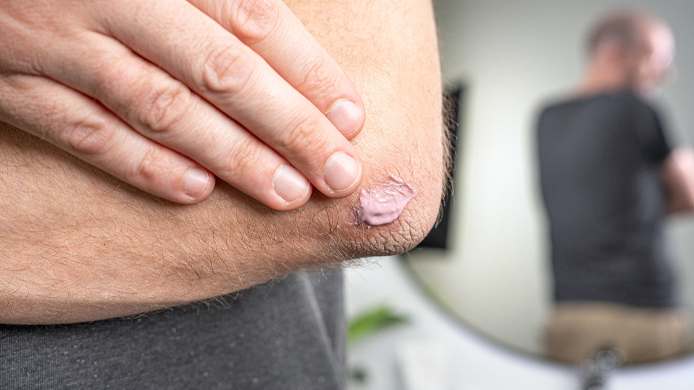 Schuppenflechte: Mann trägt DERMASENCE Vitop Psoricur Akutpflegecreme auf den Ellenbogen auf