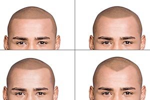 Haarpigmentierung bei Dr. Pigment Haarpigmentierung bei Dr. Pigment