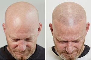 Haarpigmentierung bei Dr. Pigment Haarpigmentierung bei Dr. Pigment