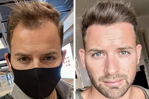 Haartransplantation Türkei vorher nachher