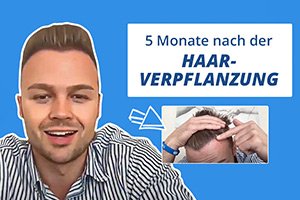 Haartransplantation Türkei vorher nachher