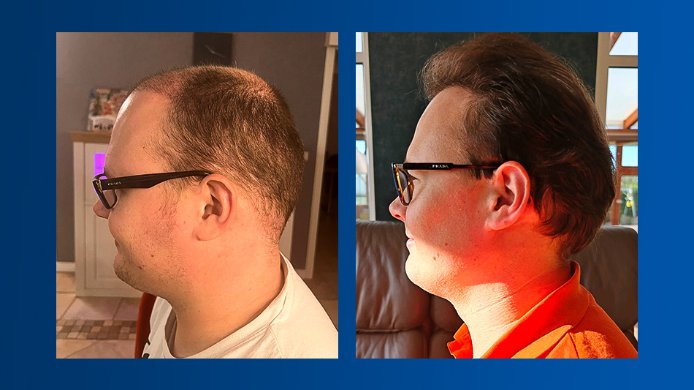 Haartransplantation Haarklinik Türkei