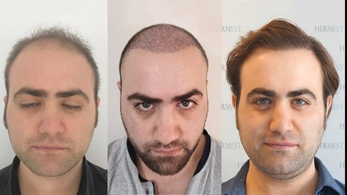 Testsieger Haartransplantation Türkei
