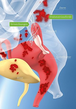 Endometriose-Therapie | Verwachsungen reduzieren