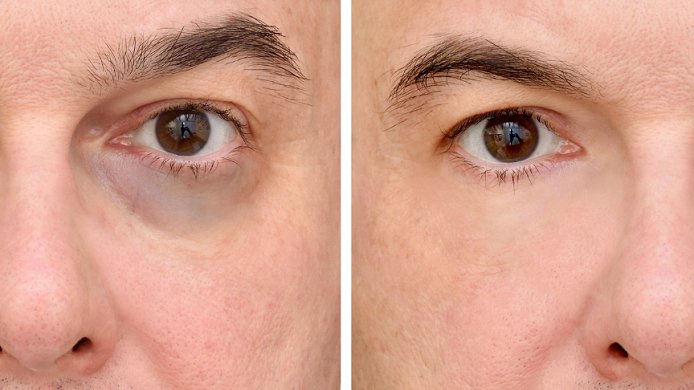 Skinbro Anti-Augenringe-Erfahrung