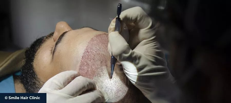 Haartransplantation Türkei Erfahrungen