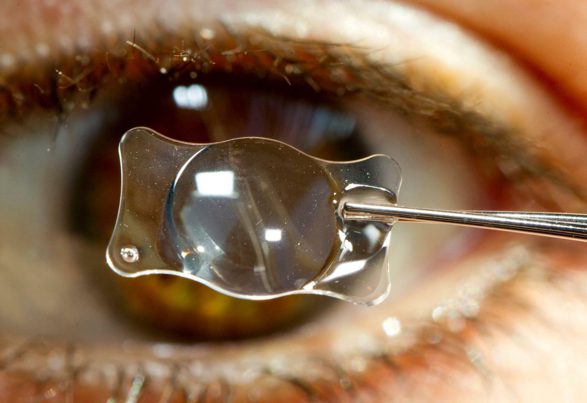 Катаракта – помутнение хрусталика глаза. Катаракта какая линза лучше. Катаракта торическая линза. Миопия и амблиопия. Катаракта какая линза лучше.